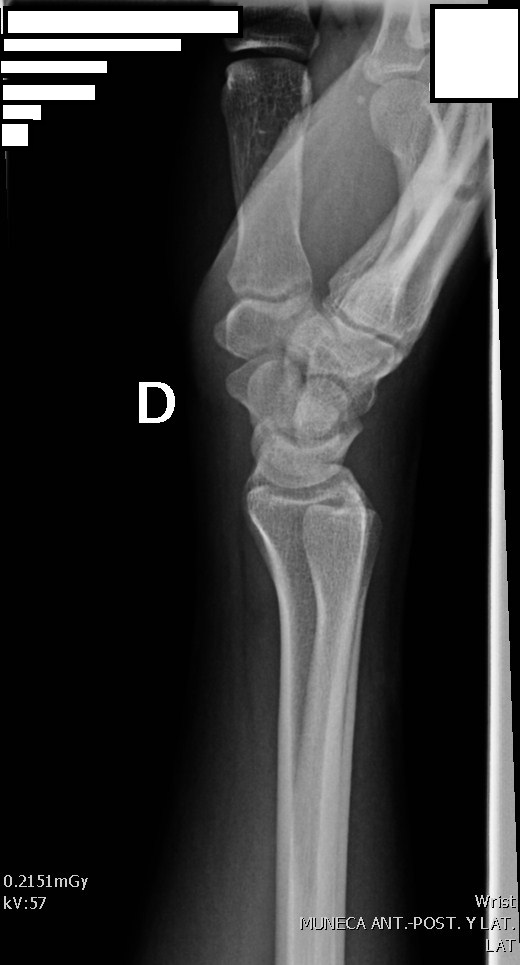 Lateral Position Diagram